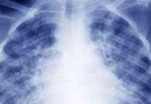 İlaç dirençli tüberküloz tedavisinde üç yeni yol bulundu ila-direnli-tberkloz-tedavisinde-yeni-yol-bulundu